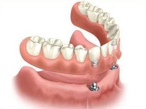 proteza dentara