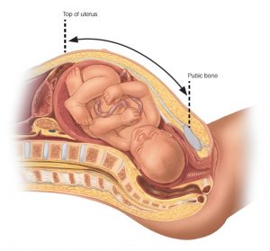 macrosomia